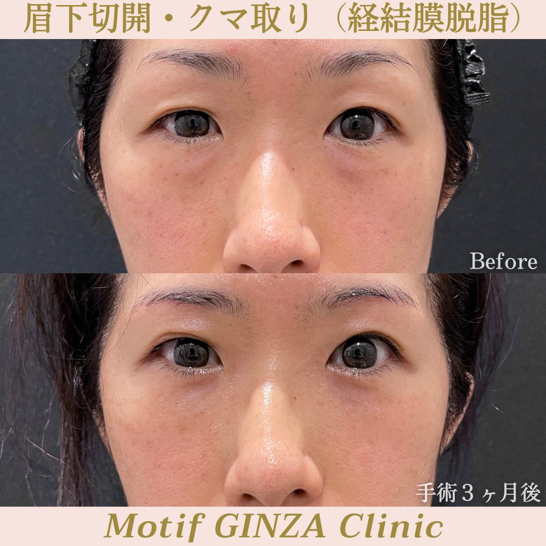 眉下切開・経結膜脱脂（手術３ヶ月）の写真
