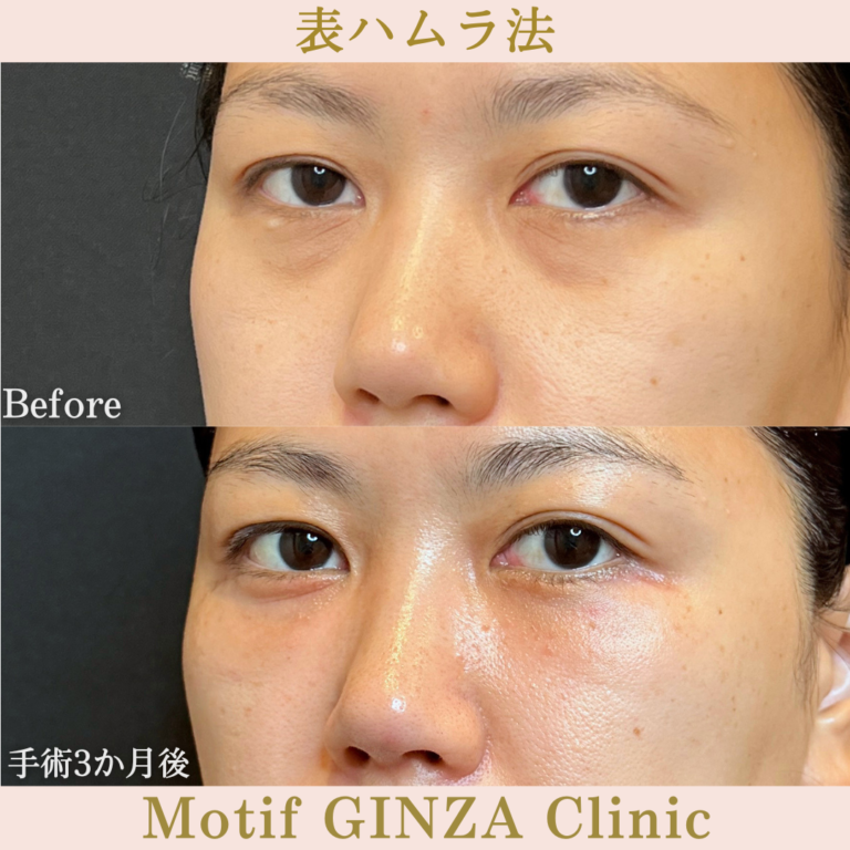 表ハムラ法（手術３か月）の写真2
