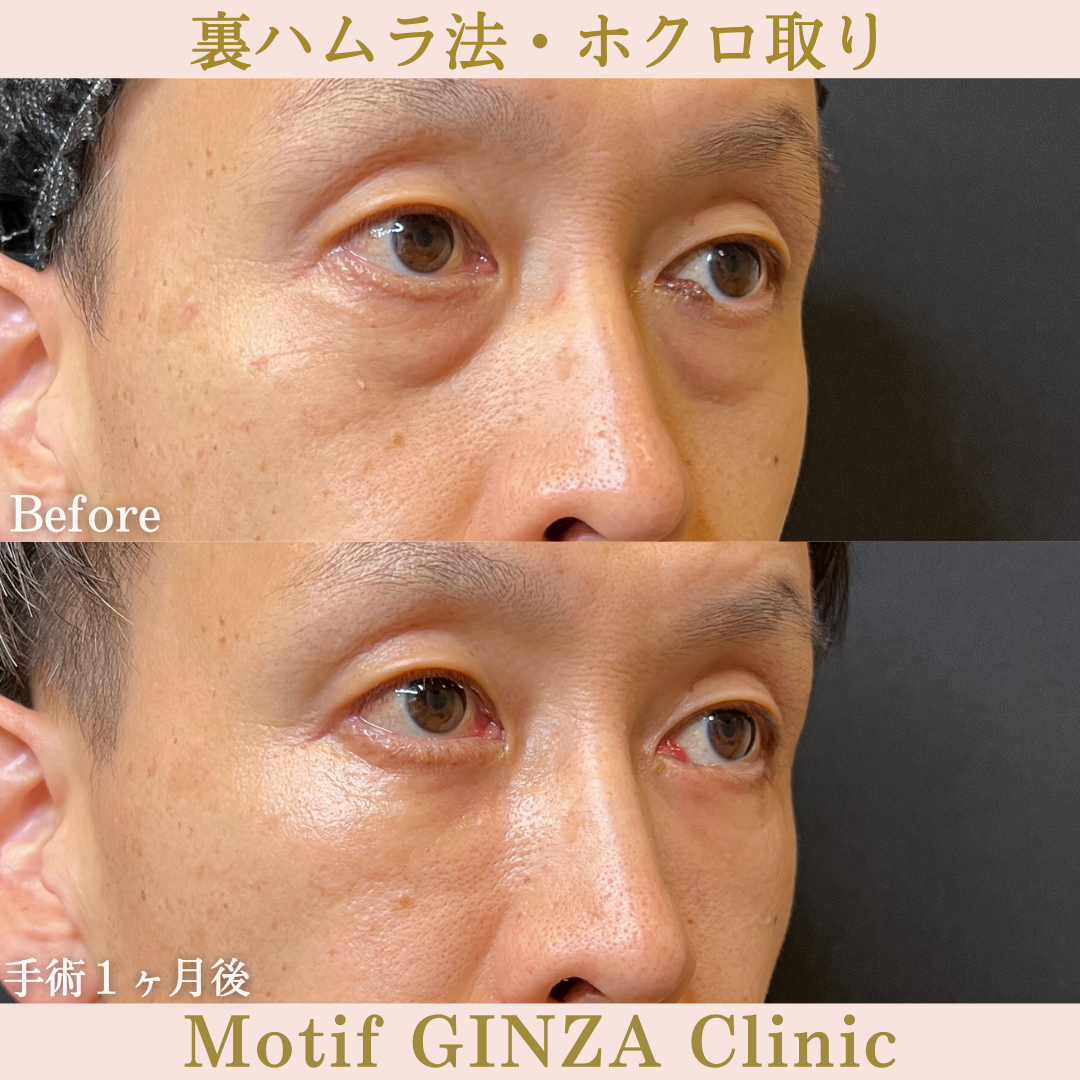 裏ハムラ法(手術6ヶ月)の写真6