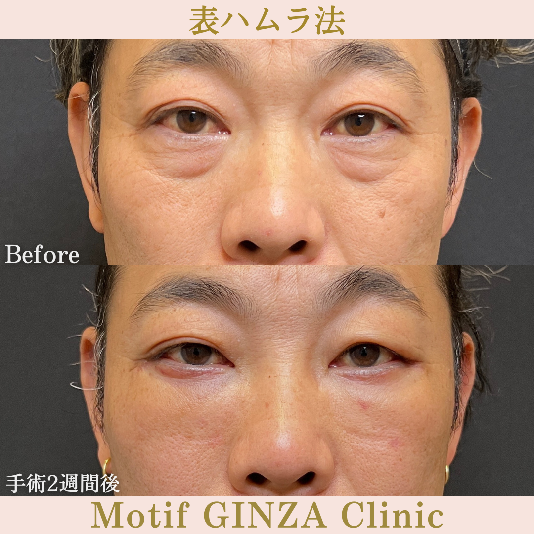 切開式下眼瞼たるみ取り(手術6ヶ月)の写真5