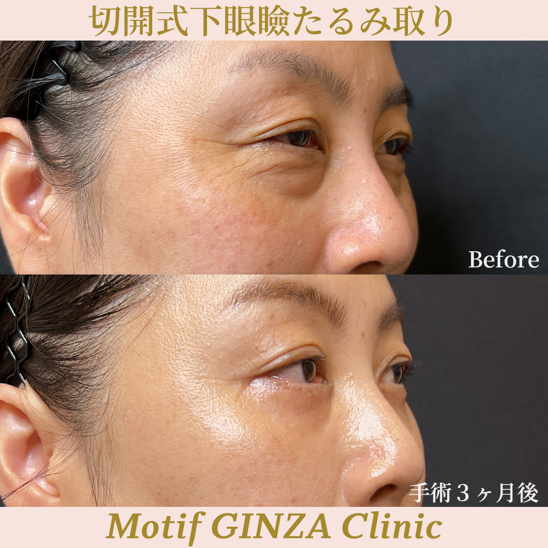 切開式下眼瞼たるみ取り（ハムラ法）（手術３ヶ月）の写真2