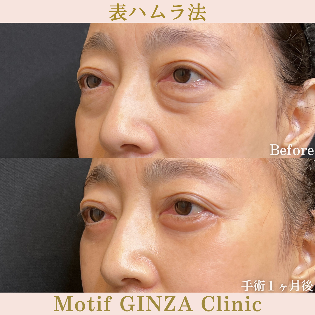 切開式下眼瞼たるみ取り（手術６ヶ月）の写真4