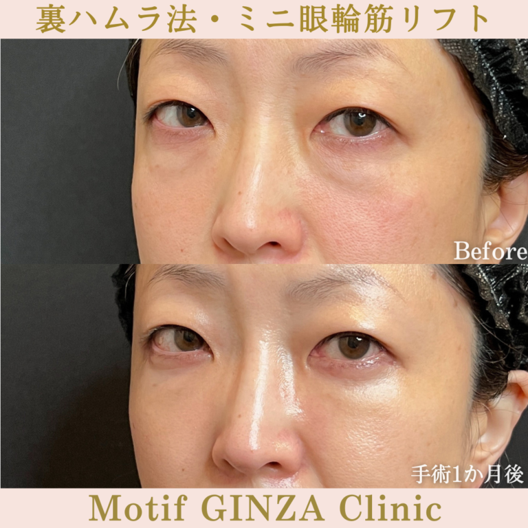 裏ハムラ法・ミニ眼輪筋リフト(手術1か月)の写真2