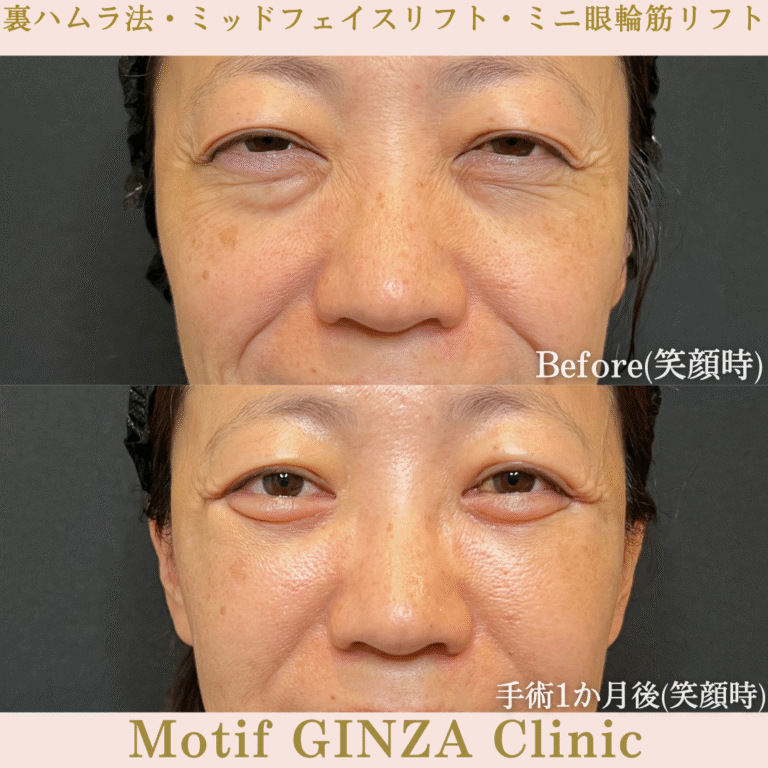 裏ハムラ法・ミッドフェイスリフト・ミニ眼輪筋リフト（手術１か月）の写真2