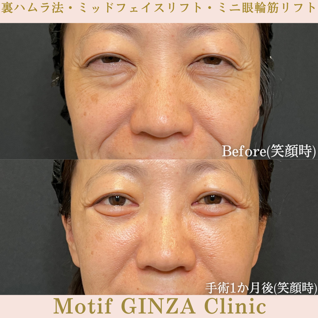 裏ハムラ法・ミッドフェイスリフト・ミニ眼輪筋リフト（手術３か月）の写真6