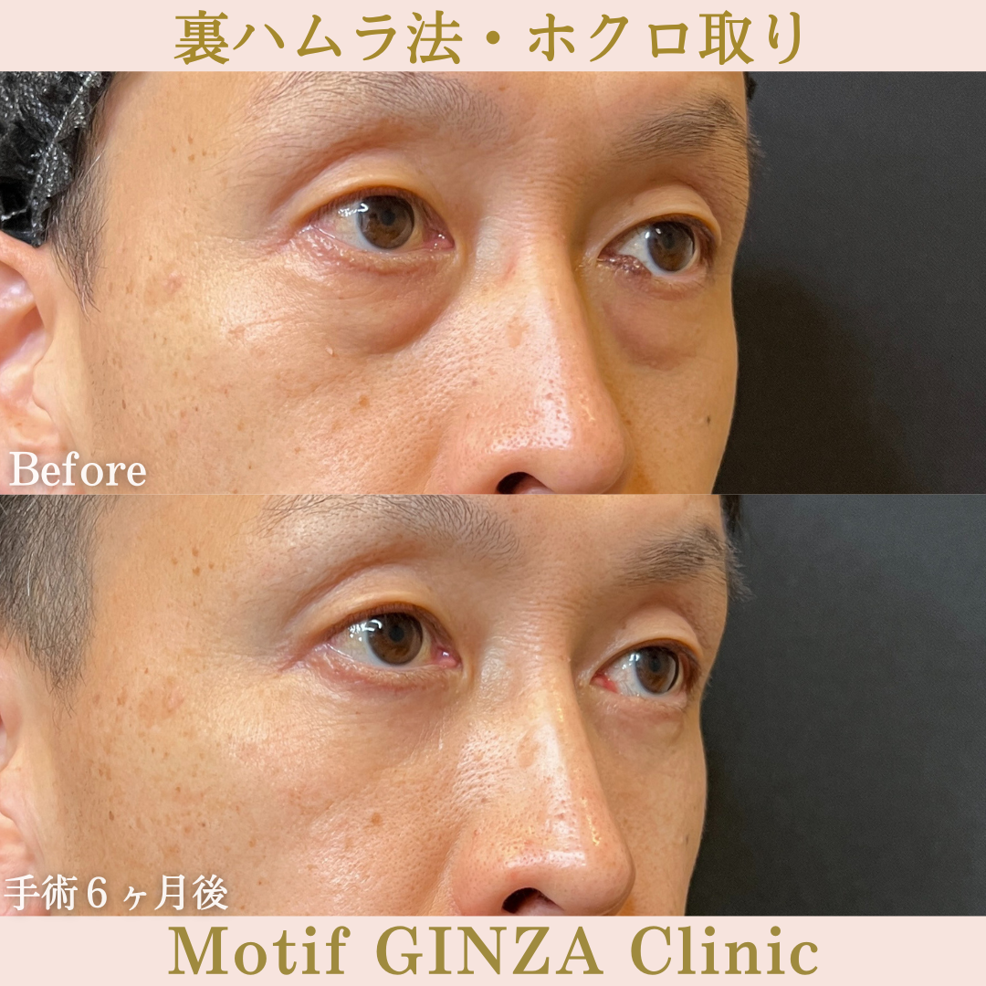 裏ハムラ法(手術6ヶ月)の写真2