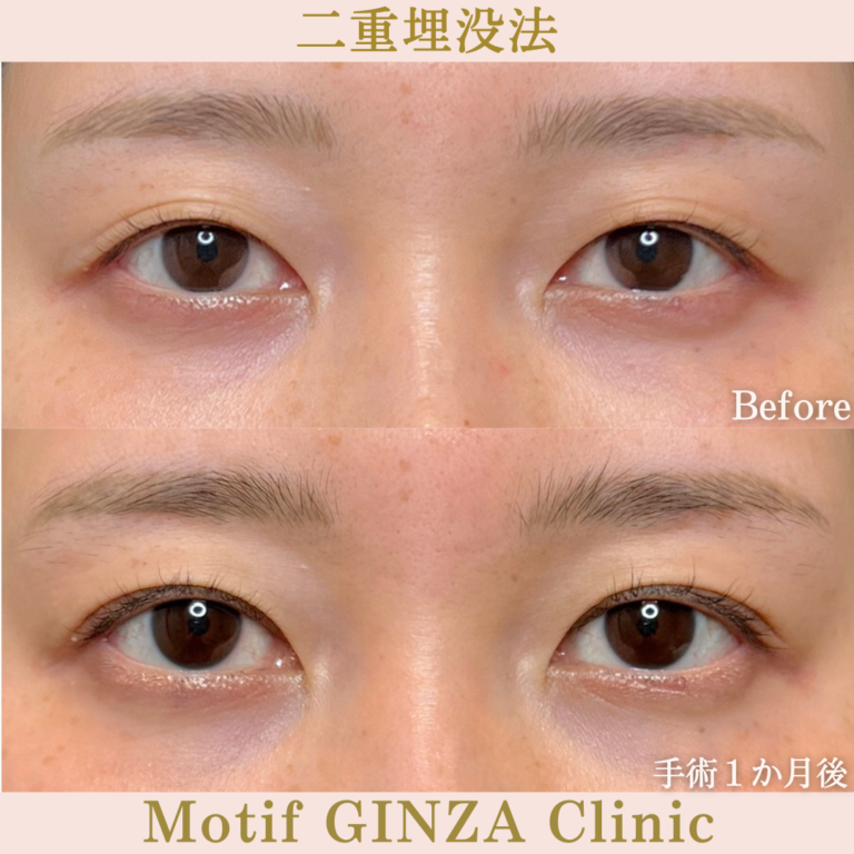 二重埋没法（手術１か月）