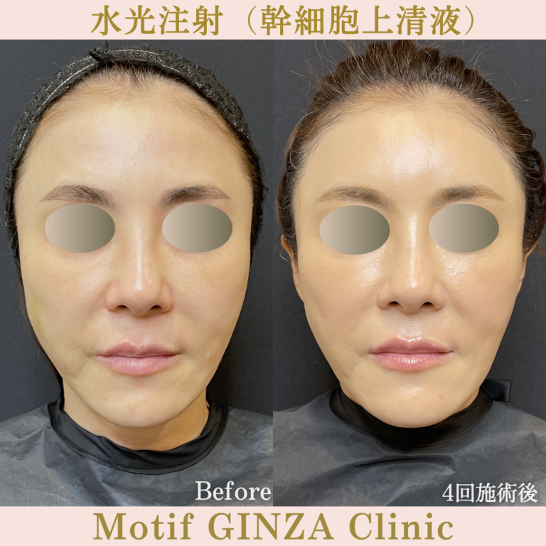 水光注射（幹細胞上清液）（４回施術後）