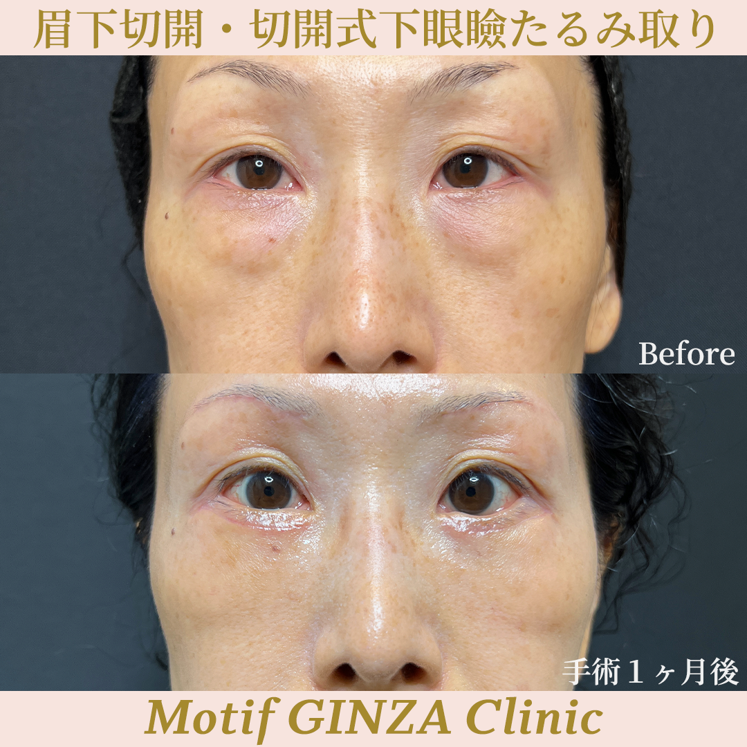 眉下切開・切開式下眼瞼たるみ取り(手術3ヶ月)の写真3