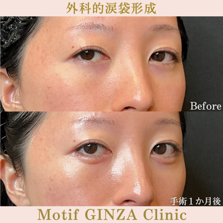 外科的涙袋形成術（手術１か月）の写真2