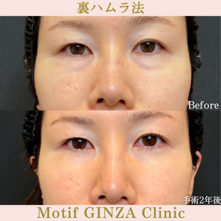 裏ハムラ法（手術2年）