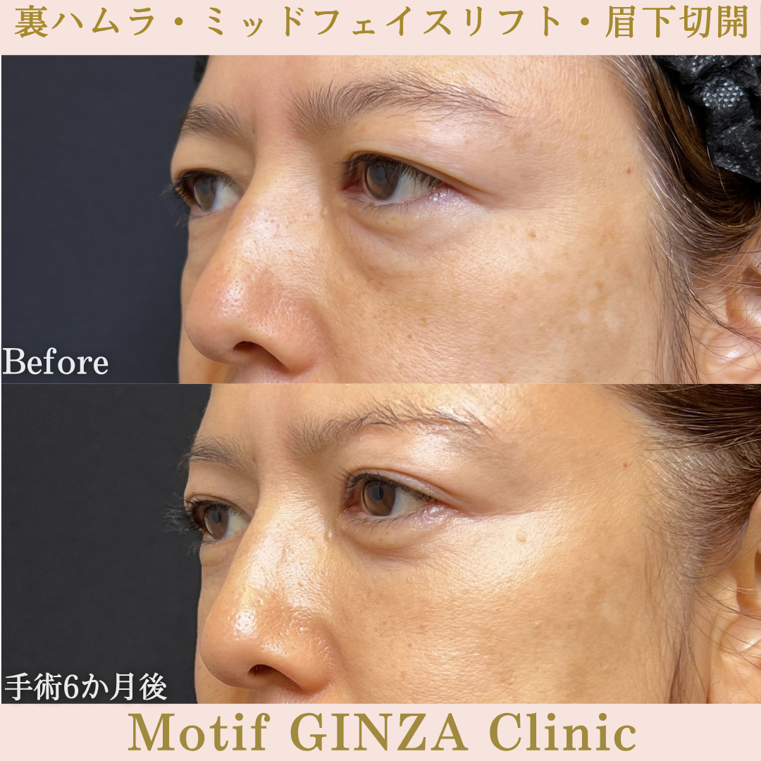 裏ハムラ法・ミッドフェイスリフト・眉下切開（手術６か月）の写真2
