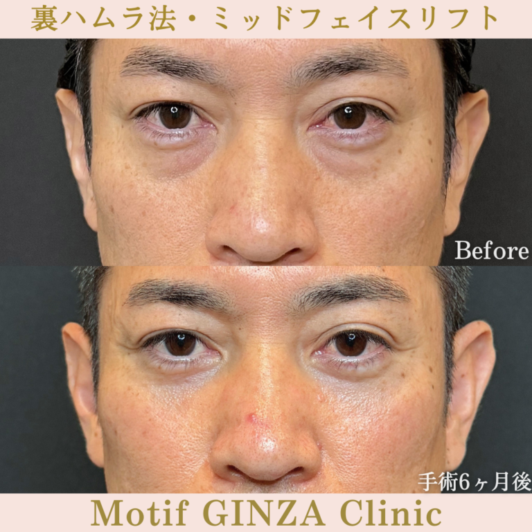 裏ハムラ法・ミッドフェイスリフト（手術6か月）