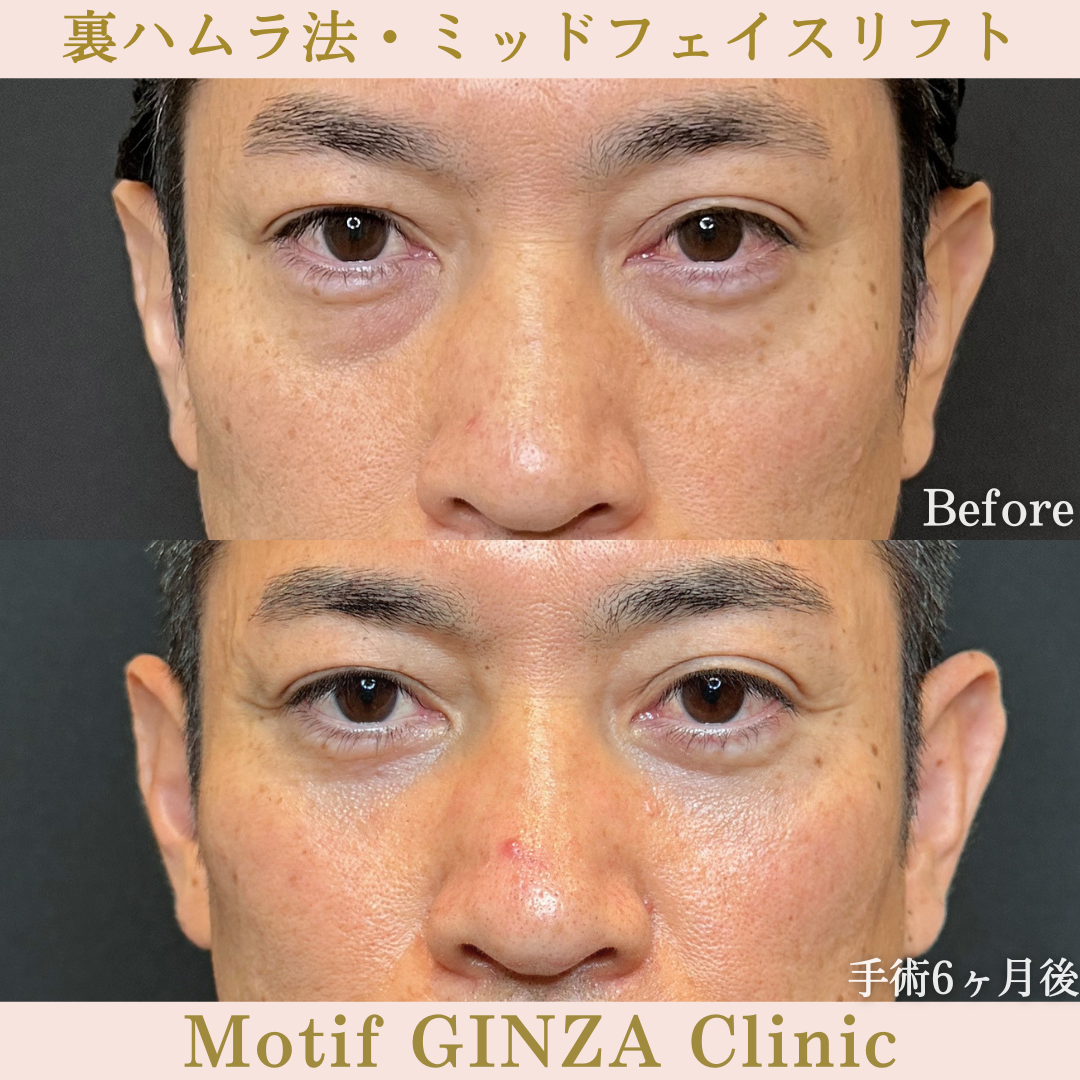 裏ハムラ法・ミッドフェイスリフト（手術6か月）の写真