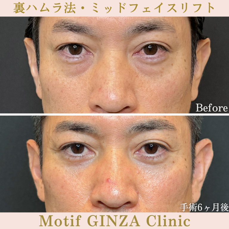 裏ハムラ法・ミッドフェイスリフト（手術6か月）
