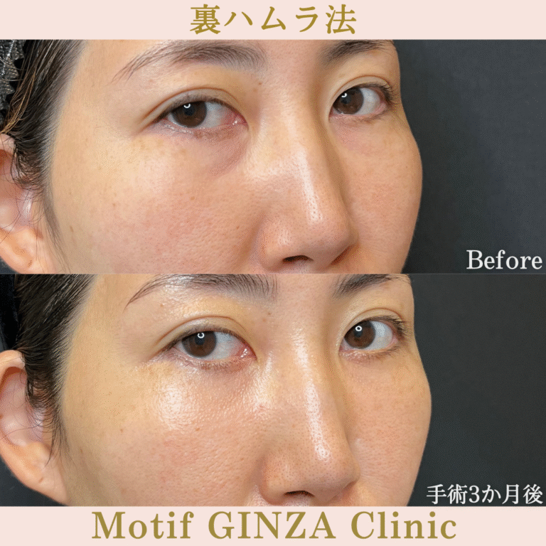 裏ハムラ法（手術３か月）の写真2