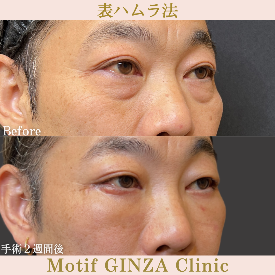 切開式下眼瞼たるみ取り(手術6ヶ月)の写真6