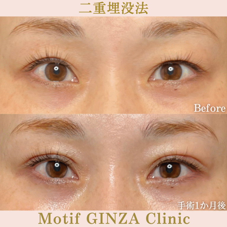 二重埋没法(手術1か月)