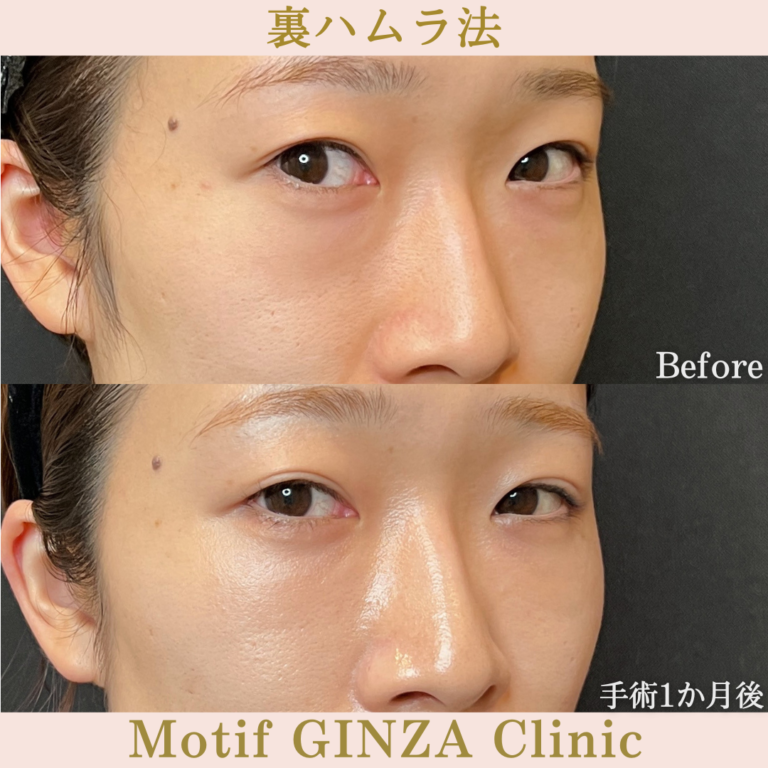 裏ハムラ法(手術1か月)の写真2