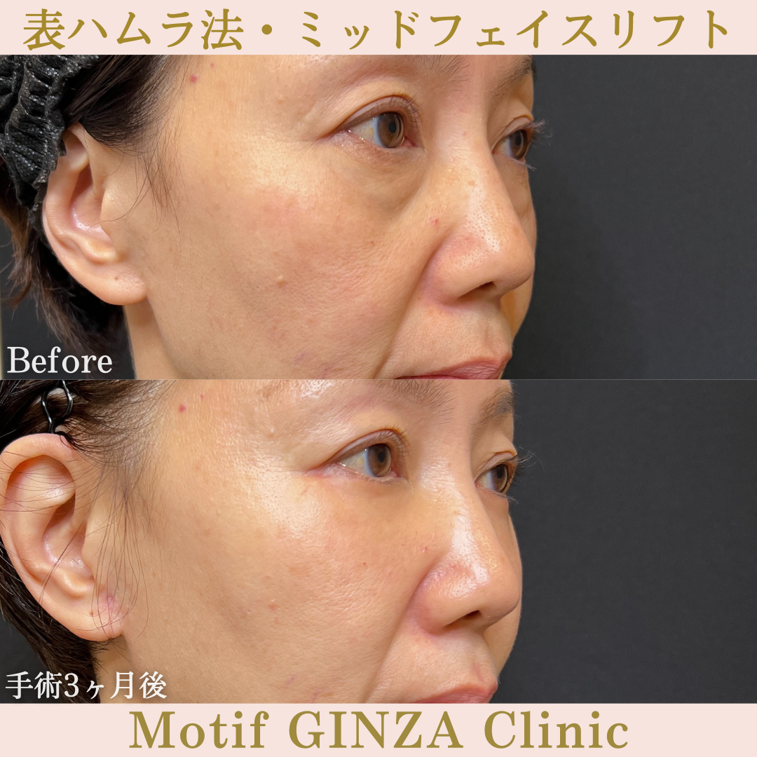 切開式下眼瞼たるみ取り・ミッドフェイスリフト(手術3ヶ月)の写真2