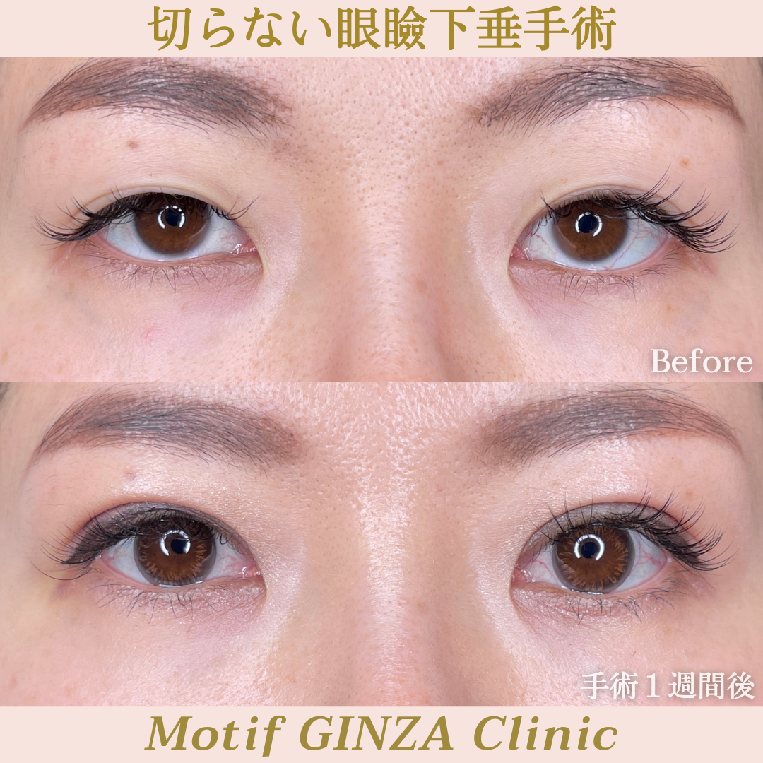 切らない眼瞼下垂手術（手術１週間）の写真