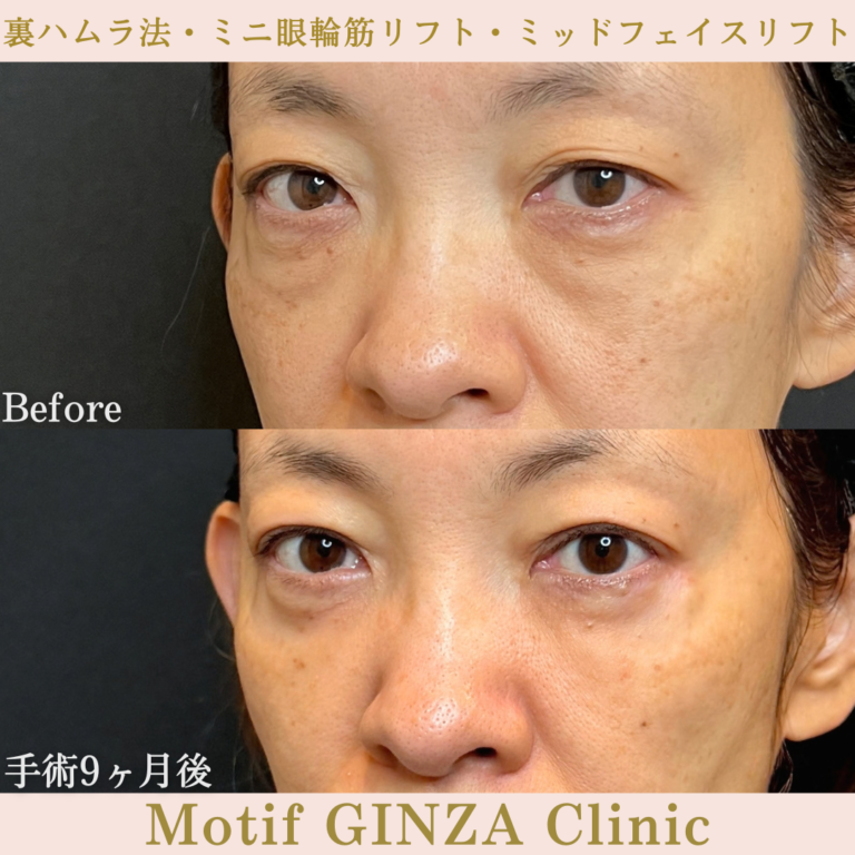 裏ハムラ法・ミニ眼輪筋リフト・ミッドフェイスリフト（手術9か月）の写真3