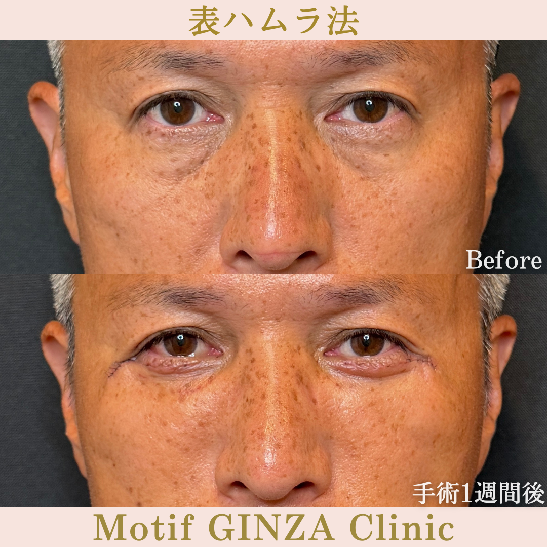 表ハムラ法（手術1か月）の写真5