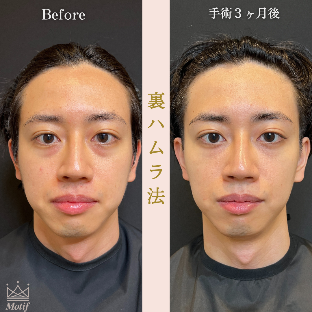 裏ハムラ法（手術３ヶ月）の写真