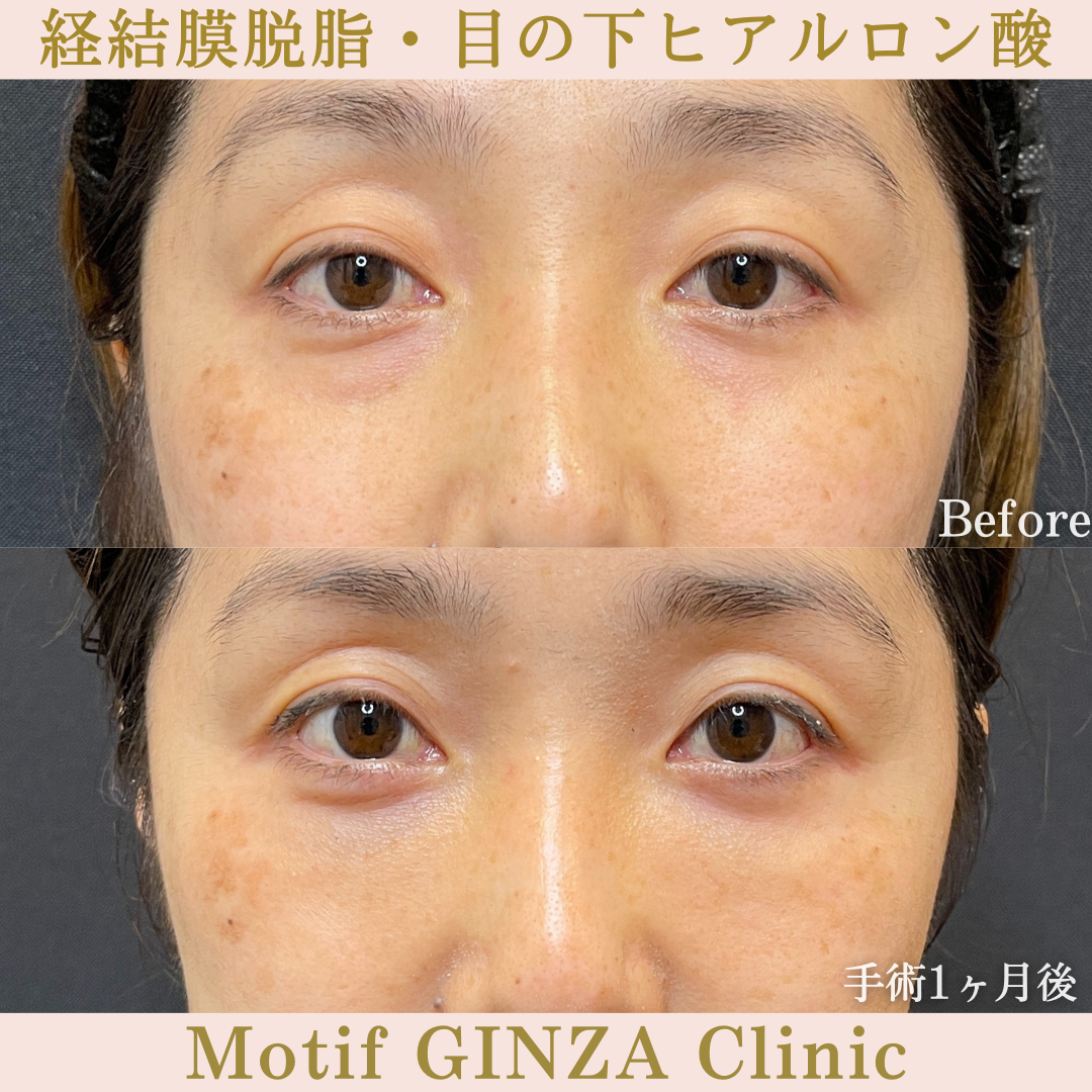 経結膜脱脂・目の下ヒアルロン酸（手術１ヶ月）の写真