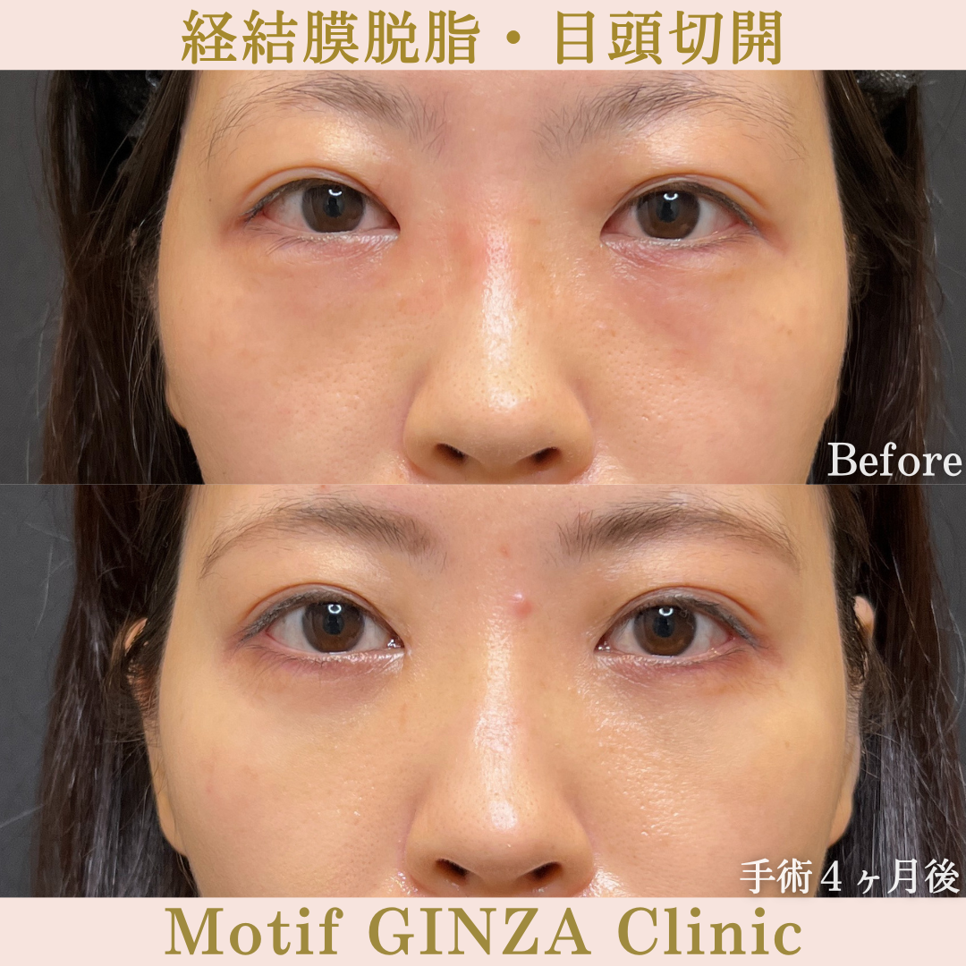 経結膜脱脂・目頭切開（手術７ヶ月）の写真3