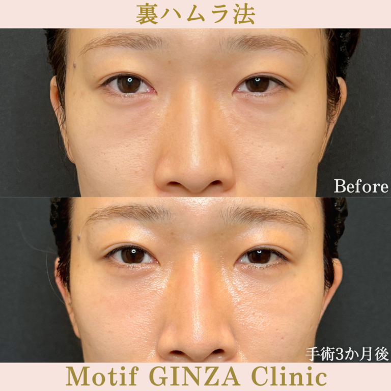 裏ハムラ法（手術3か月）