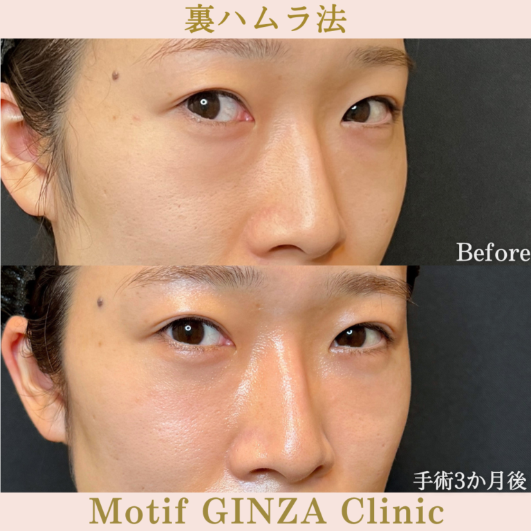 裏ハムラ法（手術3か月）の写真2