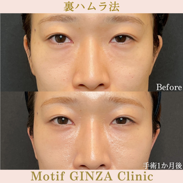 裏ハムラ法（手術１か月）