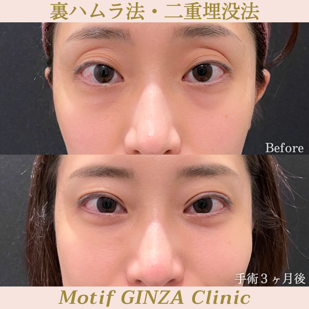 裏ハムラ法・二重埋没法（手術３ヶ月）の写真