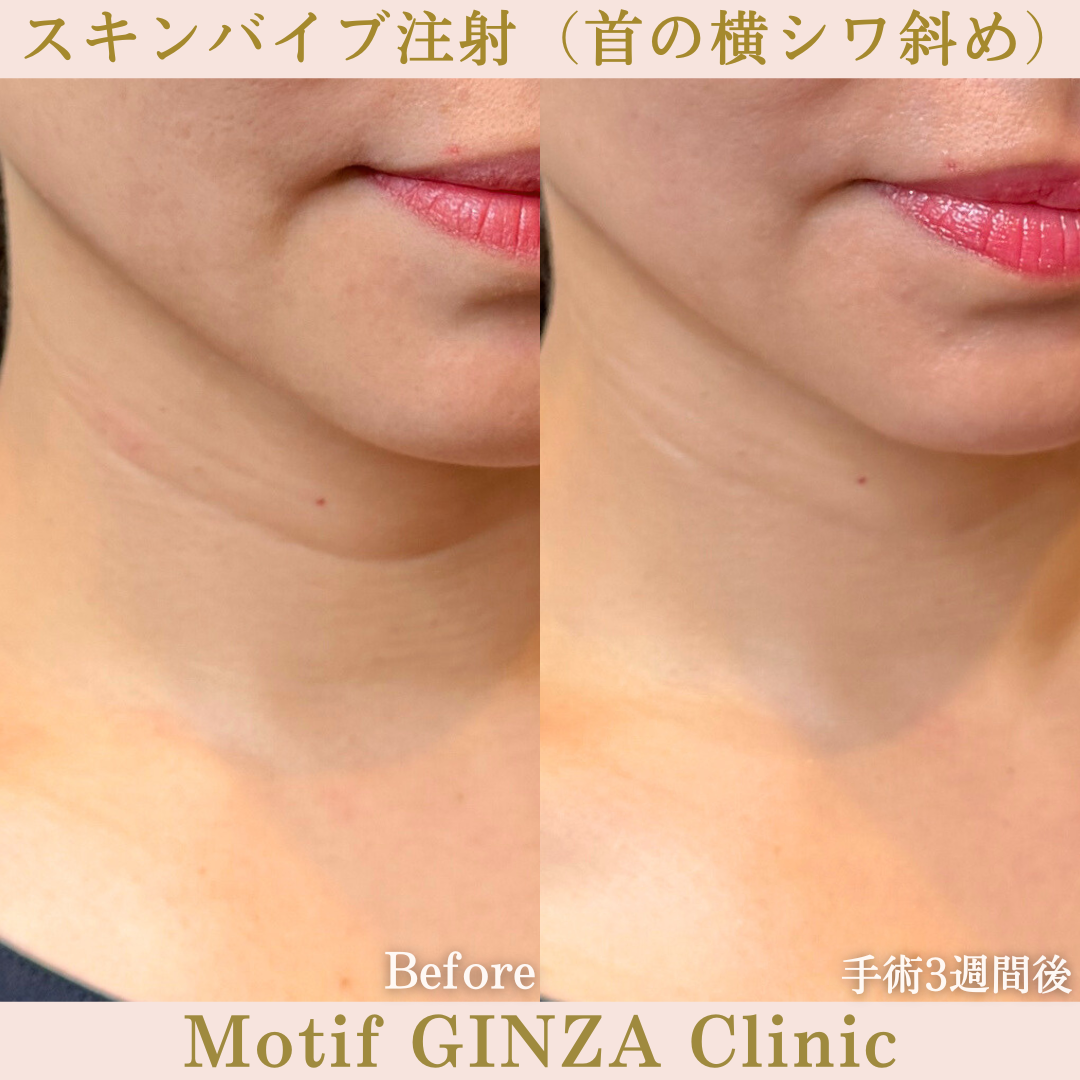 スキンバイブ注射(首の横シワ)(手術3週間)の写真2