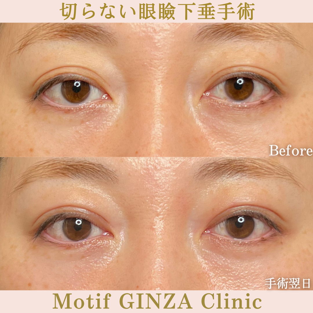 切らない眼瞼下垂手術(手術1か月)の写真3