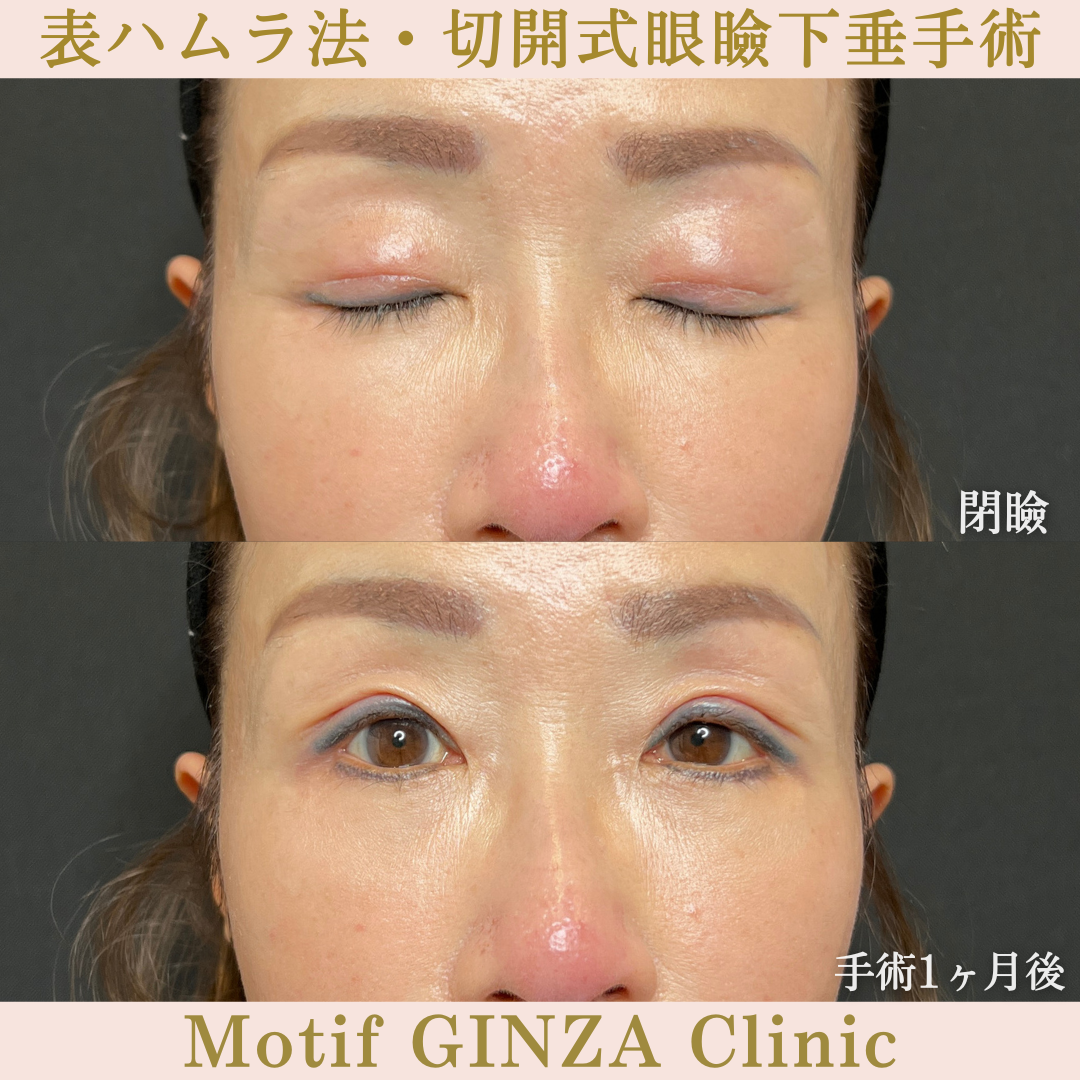 表ハムラ法・切開式眼瞼下垂手術(手術6ヶ月)の写真4