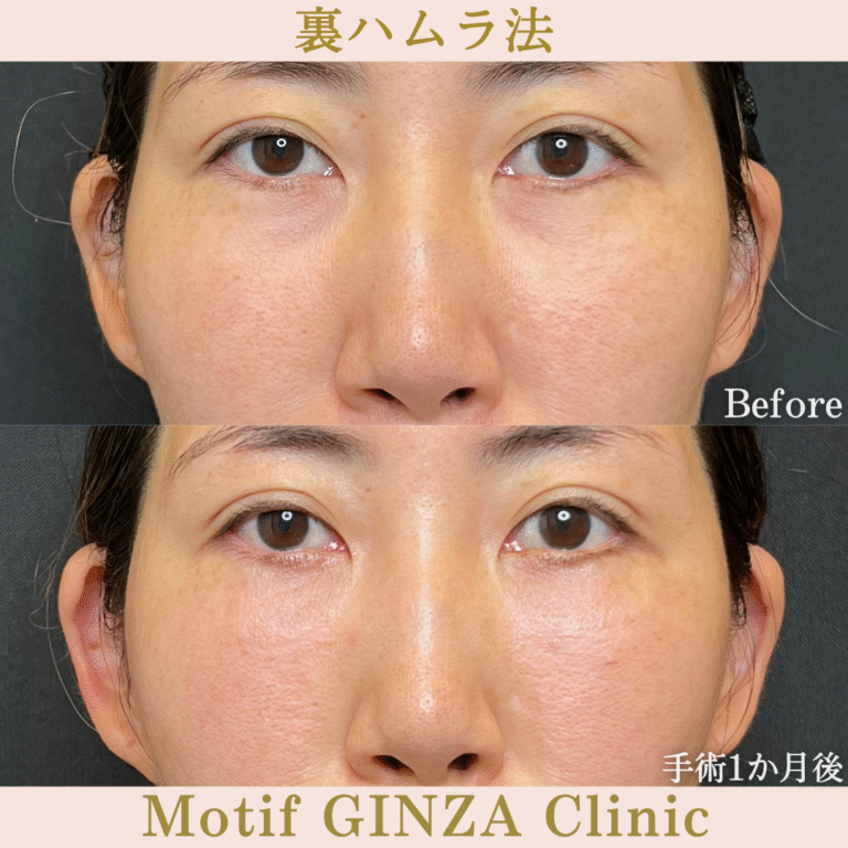 裏ハムラ法（手術３か月）の写真3