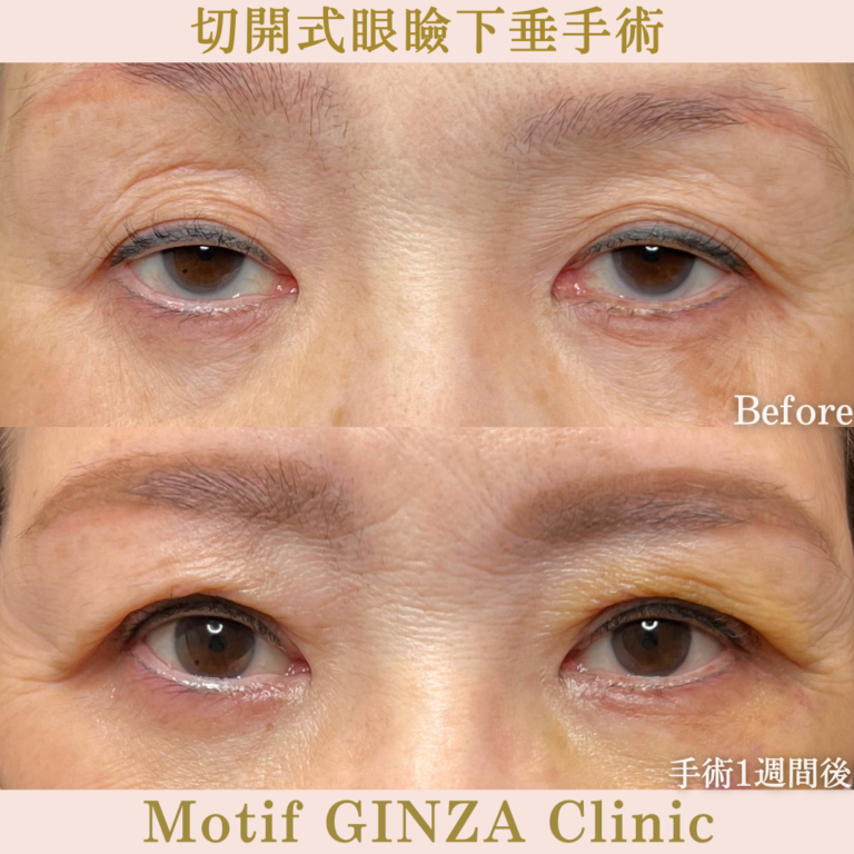 切開式眼瞼下垂手術(手術3か月)の写真5