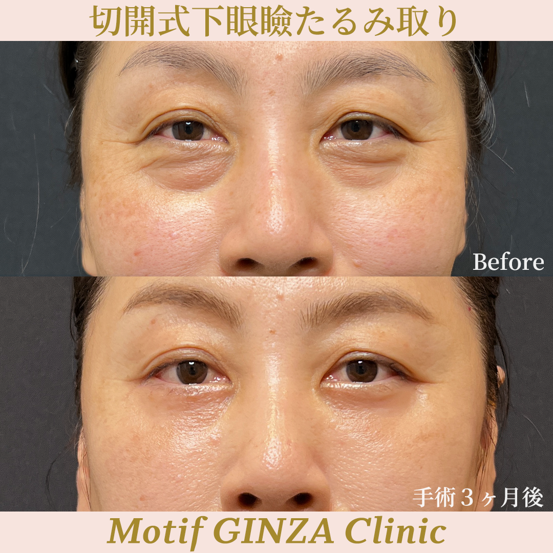 切開式下眼瞼たるみ取り（ハムラ法）（手術３ヶ月）の写真
