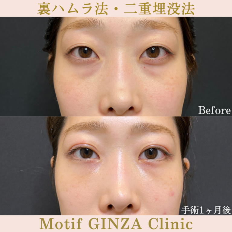 裏ハムラ法・二重埋没法(手術3か月)の写真3
