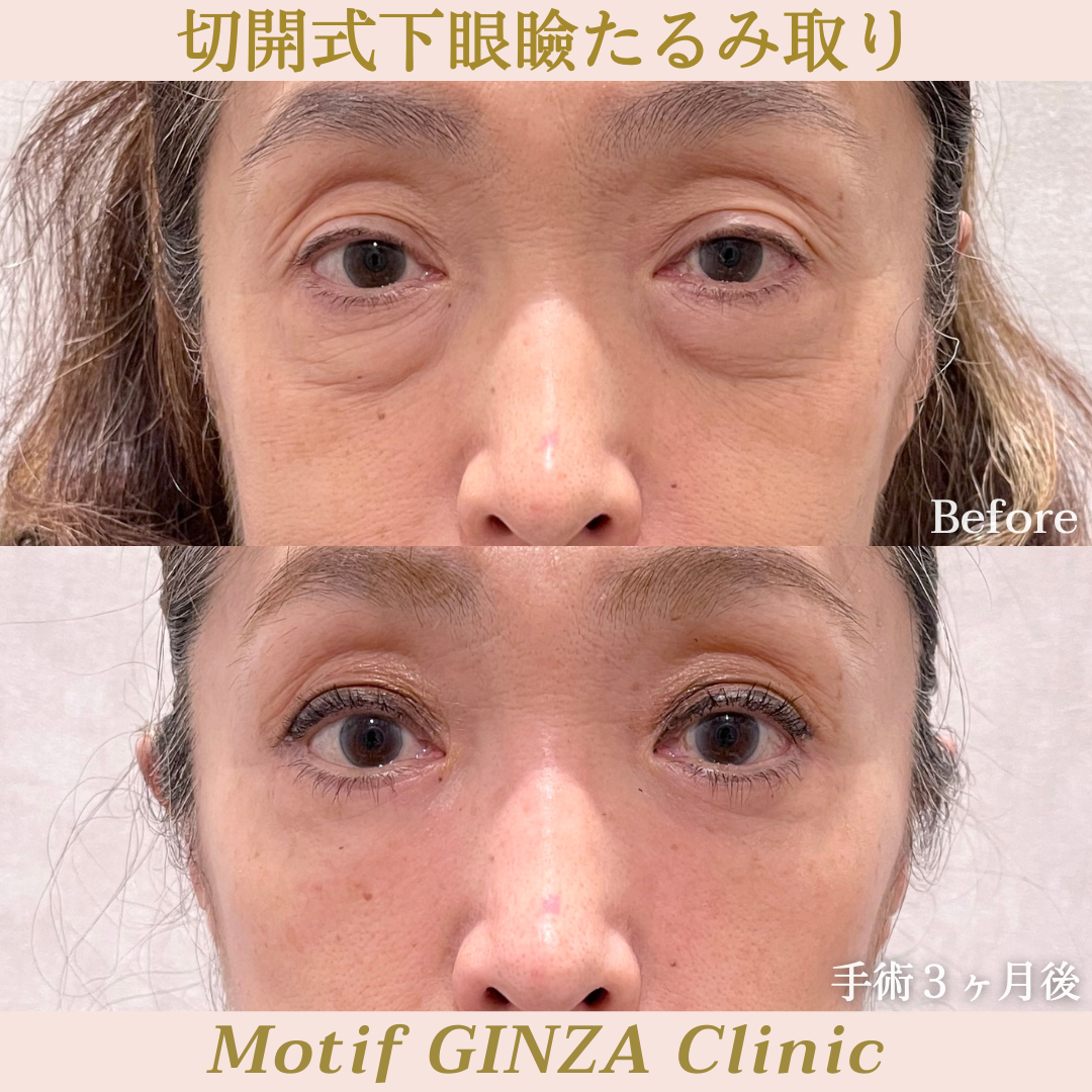 切開式下眼瞼たるみ取り（ハムラ法）（手術３ヶ月）の写真