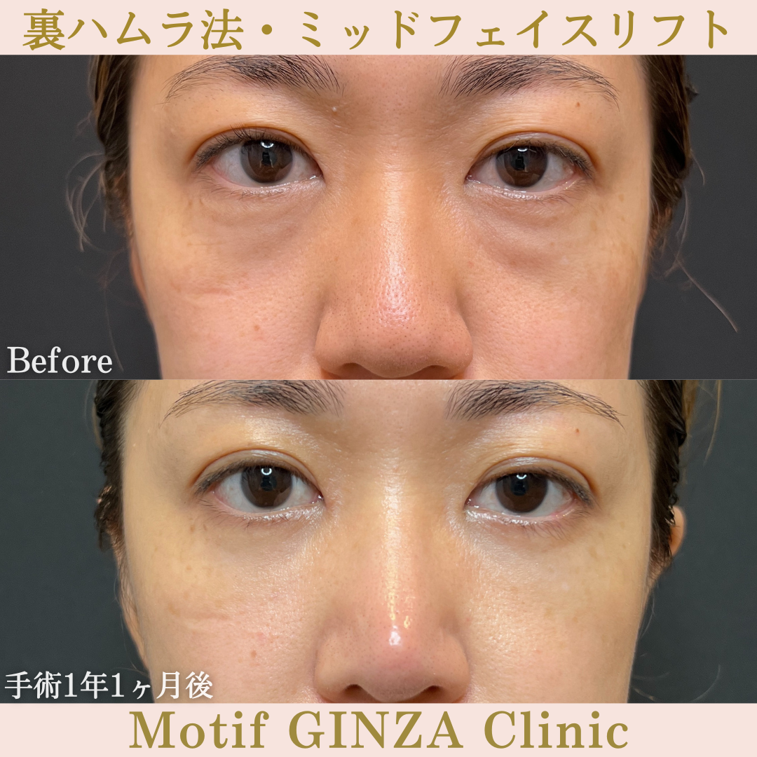 裏ハムラ法・ミッドフェイスリフト（手術１年１ヶ月）の写真