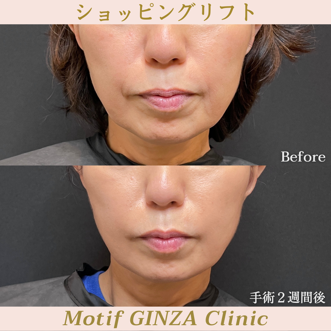 ショッピングリフト(手術2週間)の写真2