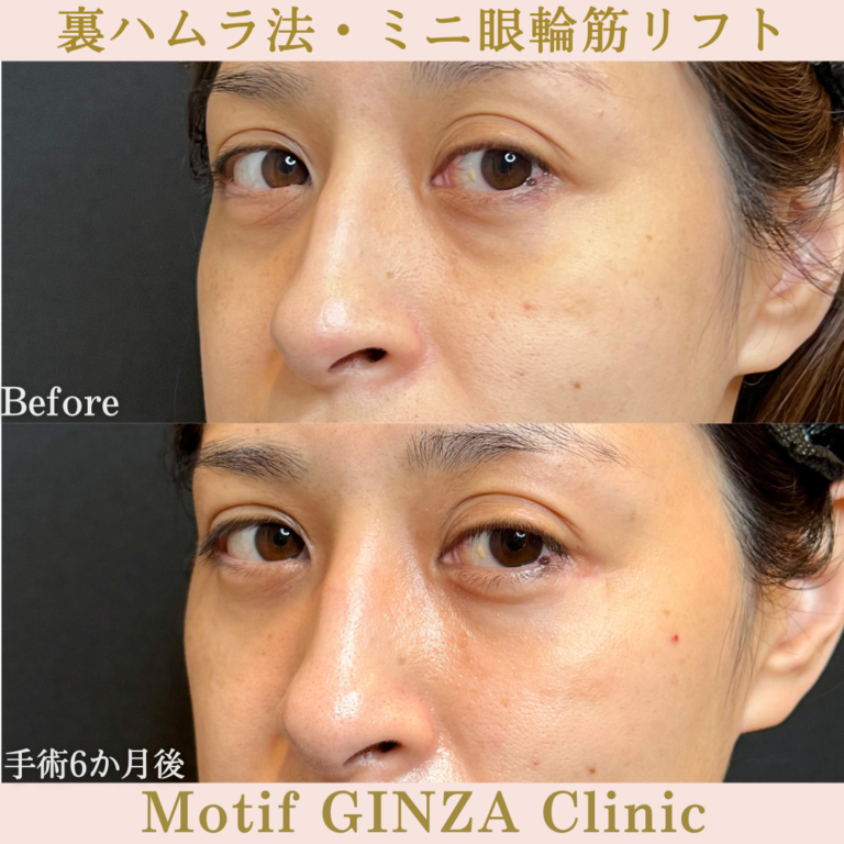 裏ハムラ法・ミニ眼輪筋リフト（手術６か月）の写真2