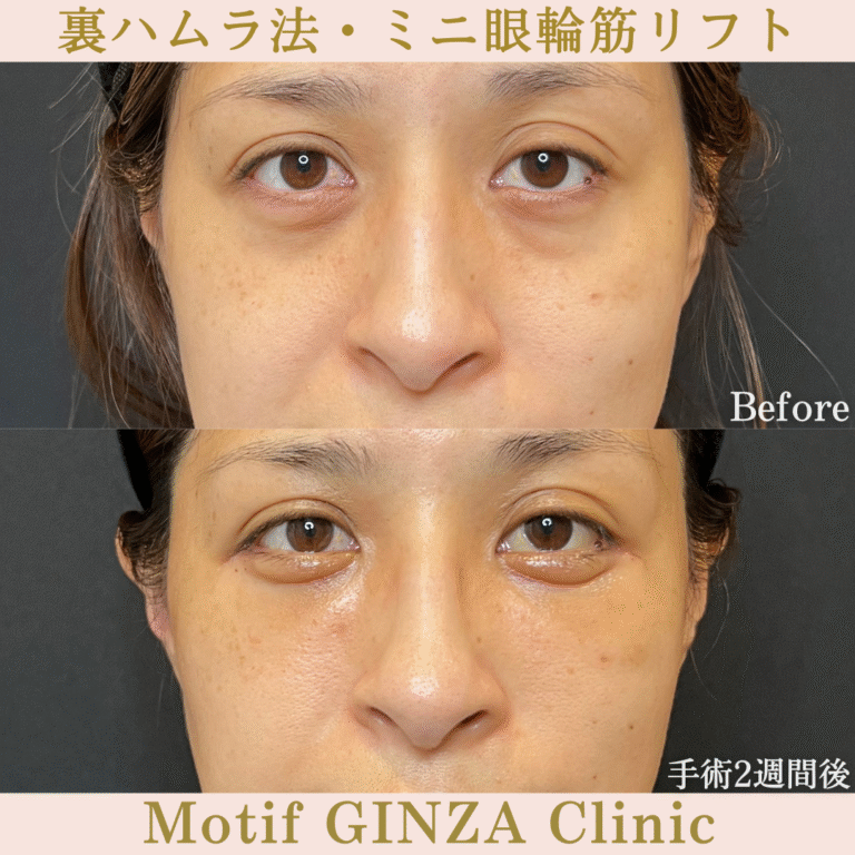 裏ハムラ法・ミニ眼輪筋リフト（手術１か月）の写真3