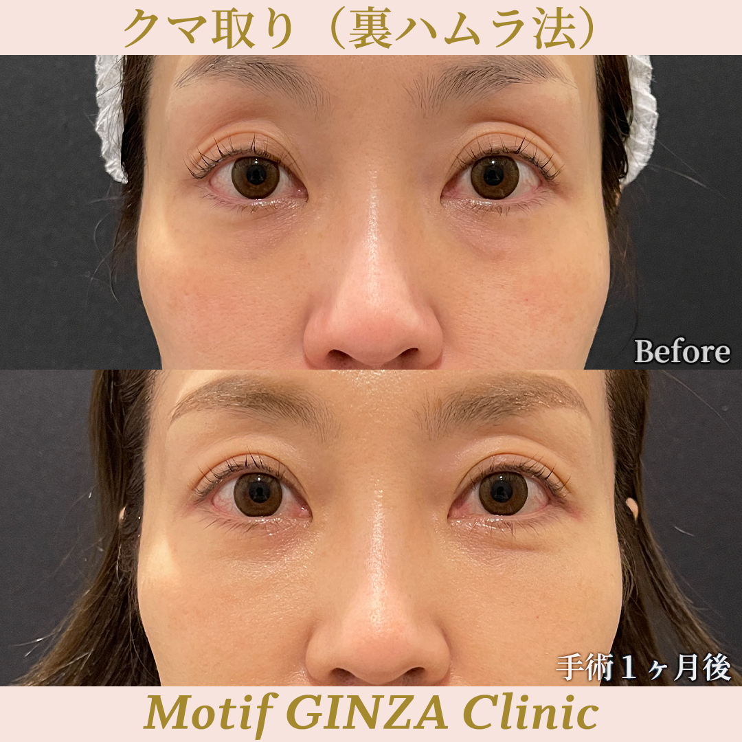 裏ハムラ法(手術3ヶ月)の写真2