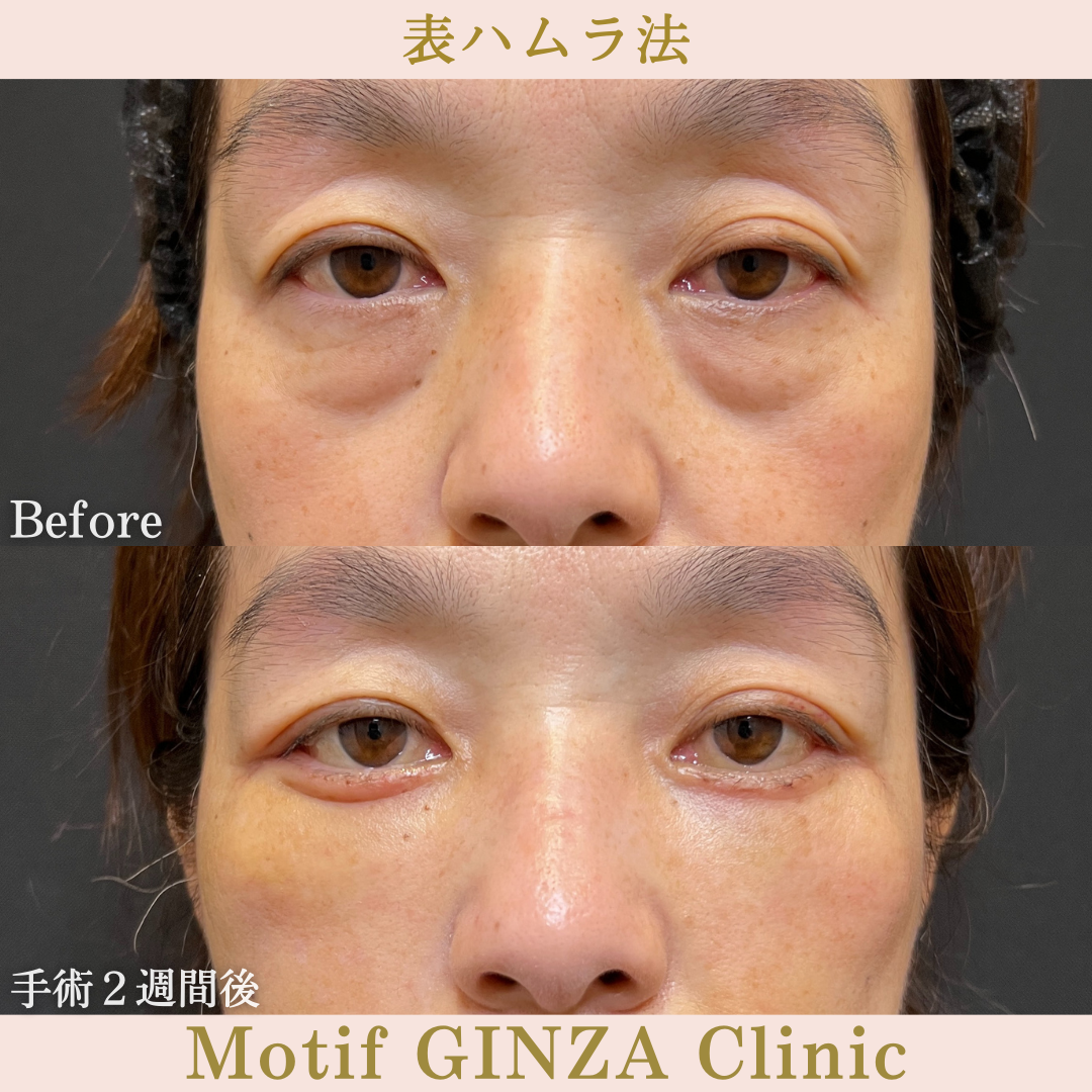 切開式下眼瞼たるみ取り・ミッドフェイスリフト（手術３ヶ月）の写真3