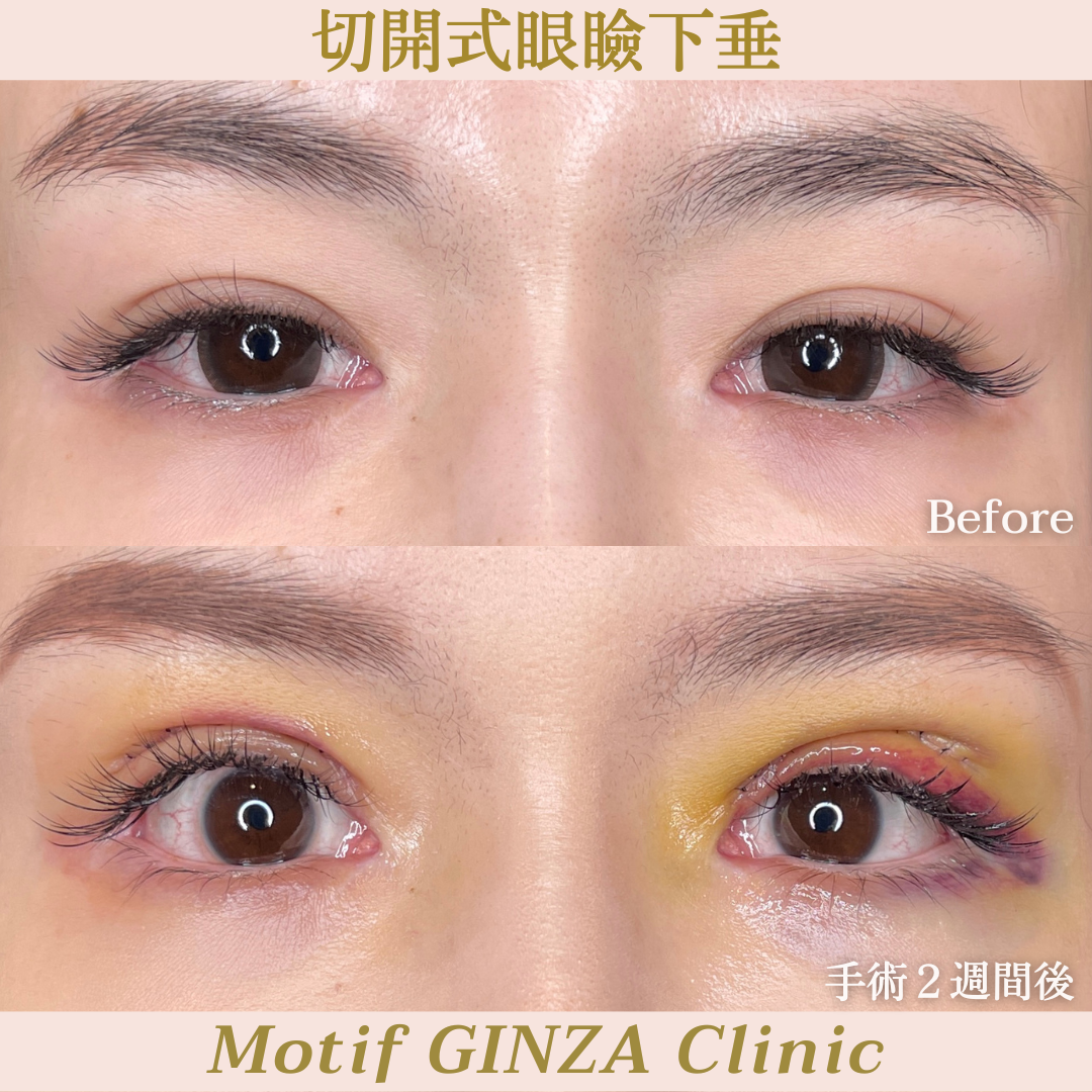 切開式眼瞼下垂手術(手術3ヶ月)の写真4