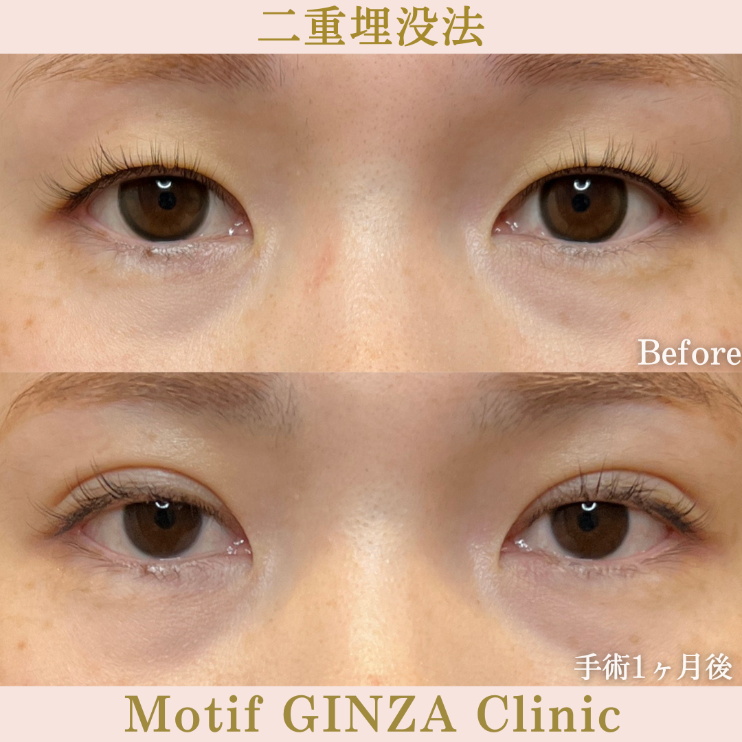 二重埋没法（手術１か月）の写真